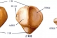 髌骨骨折健康教育（上）