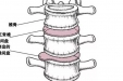 腰痛腿麻！中医理疗选哪个？！--腰椎保健专题(二)