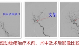 【江门首例】我院神经外科成功完成颈动脉海绵窦瘘WILLIS覆膜支架植入术