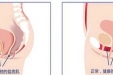 【掉下来的尴尬】浅谈子宫脱垂的手术治疗