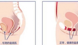 【掉下来的尴尬】浅谈子宫脱垂的手术治疗
