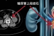 【科普作品】小小尿路结石险致命？原来是并发尿源性脓毒血症