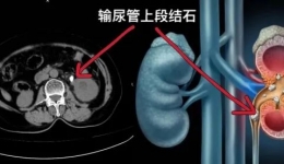 【科普作品】小小尿路结石险致命？原来是并发尿源性脓毒血症