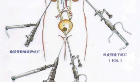 【医学科普】疯狂的“石头”——泌尿系结石