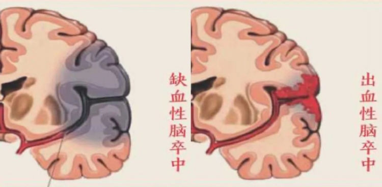 【卒中科普知识系列三】如何减少脑卒中的发病和复发