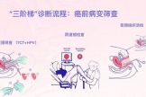 【健康科普】带您了解宫颈癌