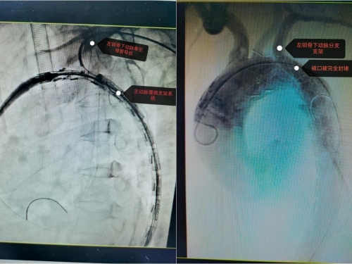 开平首例！市中心医院 “拆弹” 成功 —— 分体式支架精准破解 Stanford B 型主动脉夹层，这些高危人群要警惕！