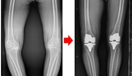 守护膝关节健康，且行且珍“膝”——严重膝关节病变，膝关节置换能帮到您！