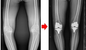 守护膝关节健康，且行且珍“膝”——严重膝关节病变，膝关节置换能帮到您！