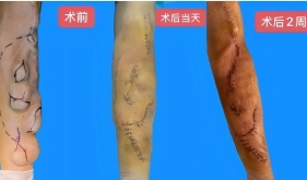 “生命线”告急！五处血管瘤+内瘘失功，开平医护一台手术“双杀”破局